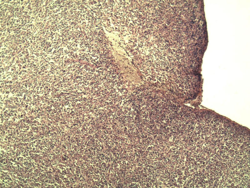 腹股沟 多枚淋巴结活检图6