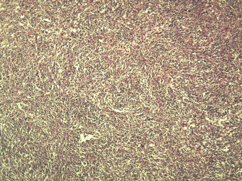 腹股沟 多枚淋巴结活检图7