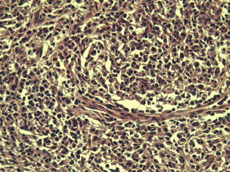 腹股沟 多枚淋巴结活检图8