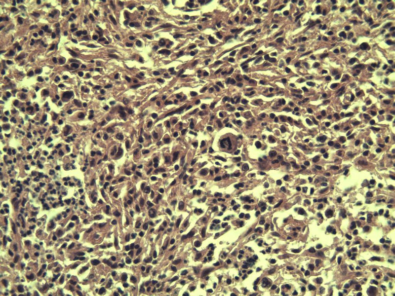 腹股沟 多枚淋巴结活检图9