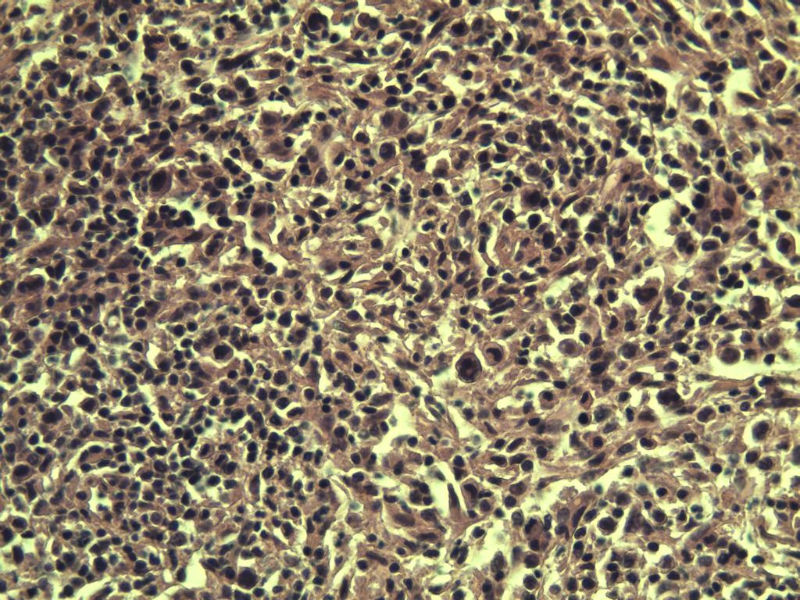 腹股沟 多枚淋巴结活检图10