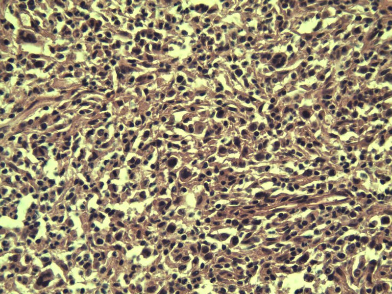 腹股沟 多枚淋巴结活检图11