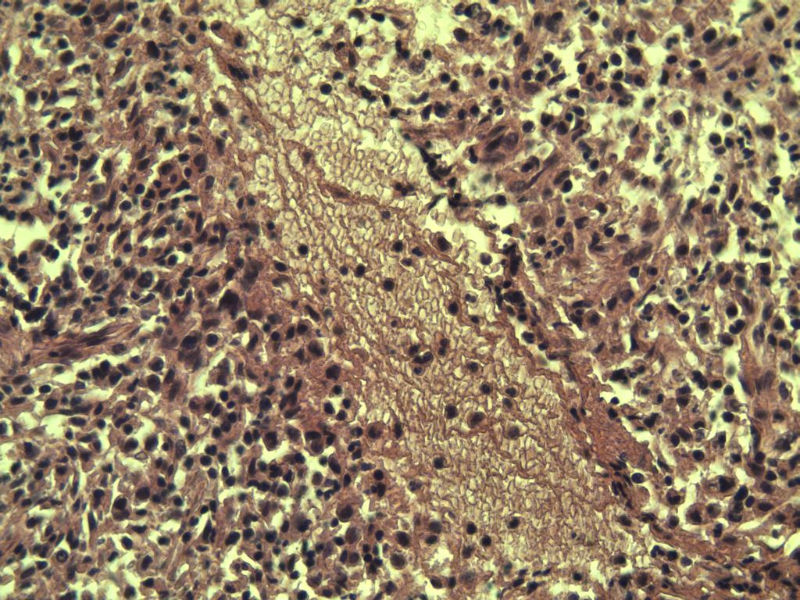 腹股沟 多枚淋巴结活检图12