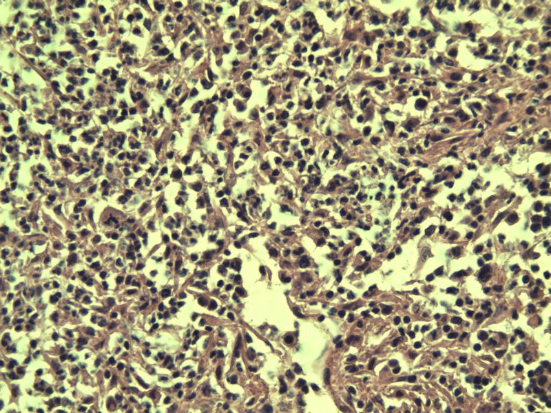 腹股沟 多枚淋巴结活检图13