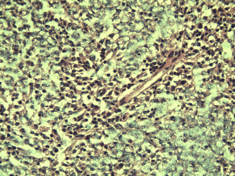 腹股沟 多枚淋巴结活检图14