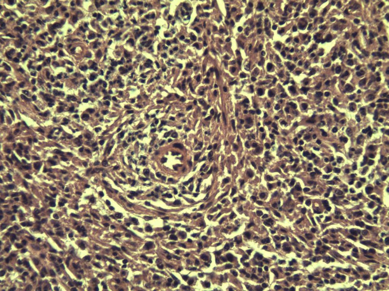 腹股沟 多枚淋巴结活检图15
