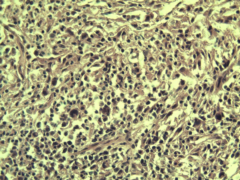 腹股沟 多枚淋巴结活检图16