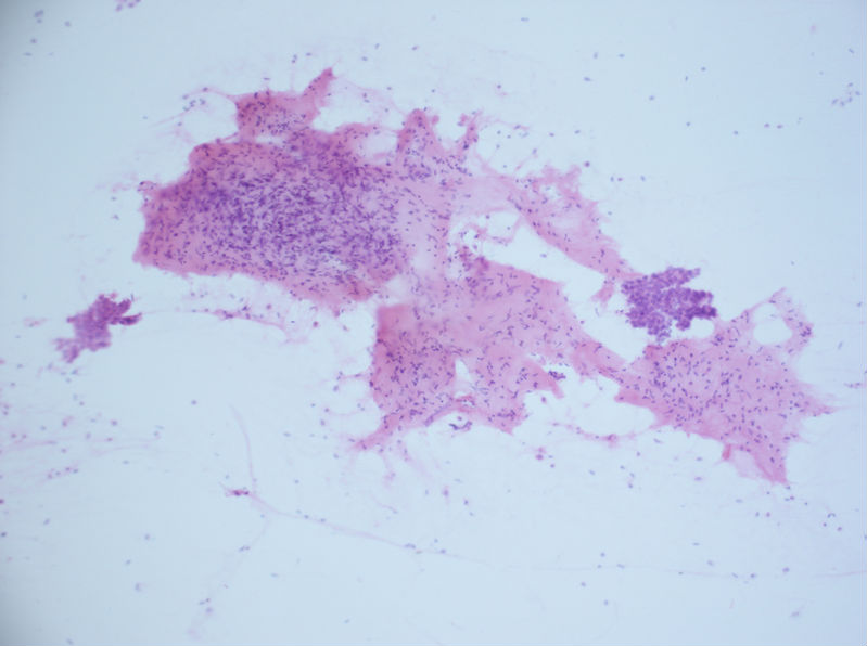 病例分享——女性，乳腺肿块穿刺。图1