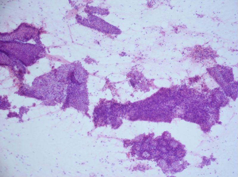 病例分享——女性，乳腺肿块穿刺。图2