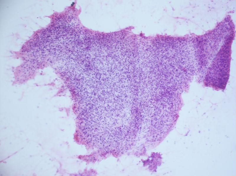 病例分享——女性，乳腺肿块穿刺。图3