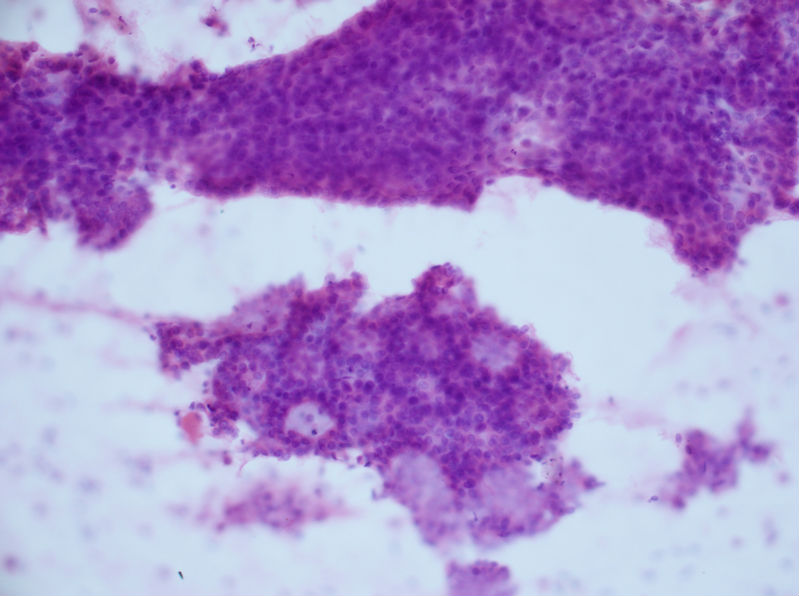 病例分享——女性，乳腺肿块穿刺。图5