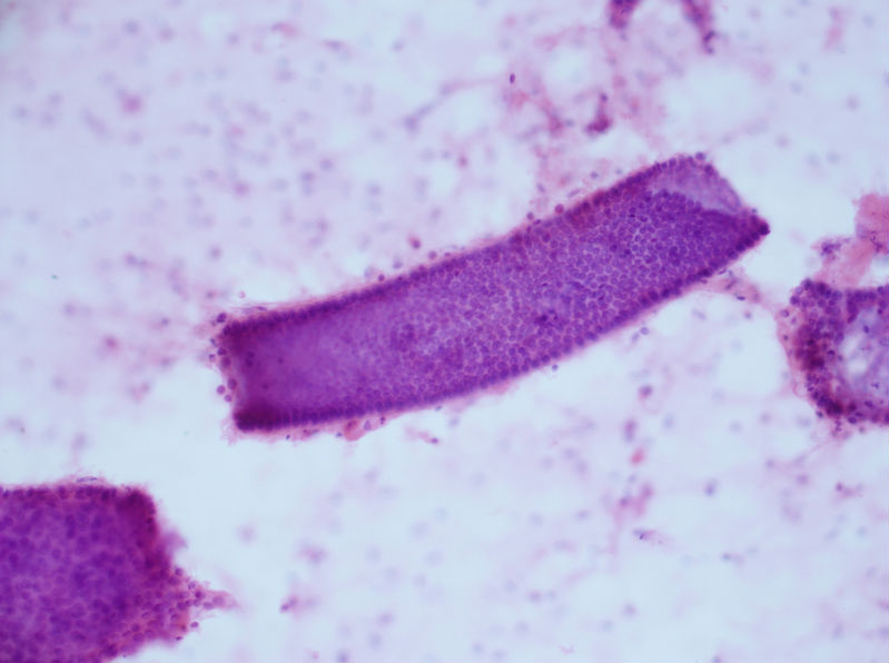 病例分享——女性，乳腺肿块穿刺。图6