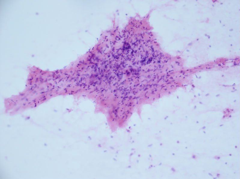 病例分享——女性，乳腺肿块穿刺。图7