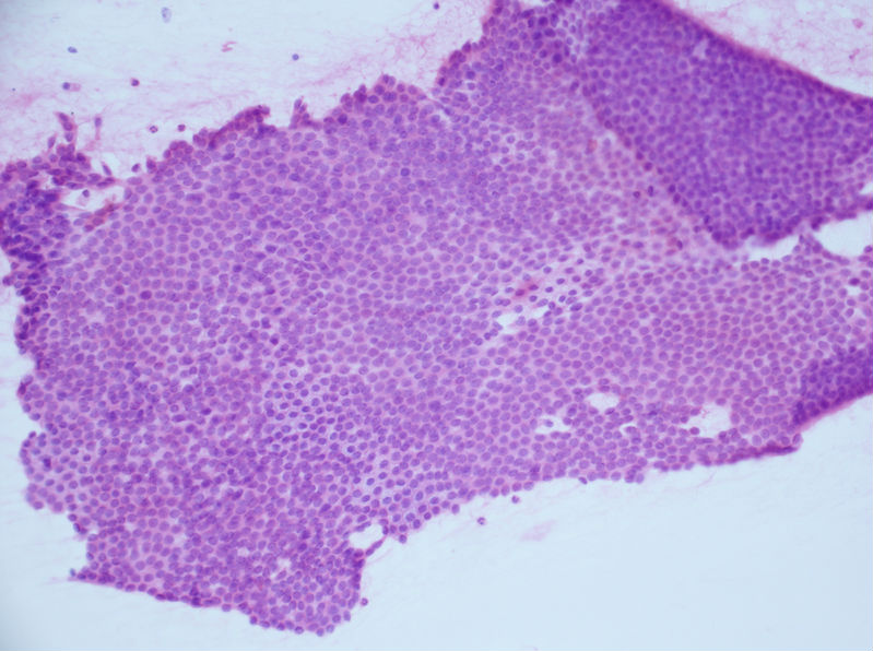 病例分享——女性，乳腺肿块穿刺。图8