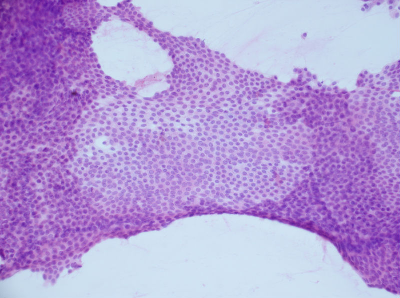 病例分享——女性，乳腺肿块穿刺。图9