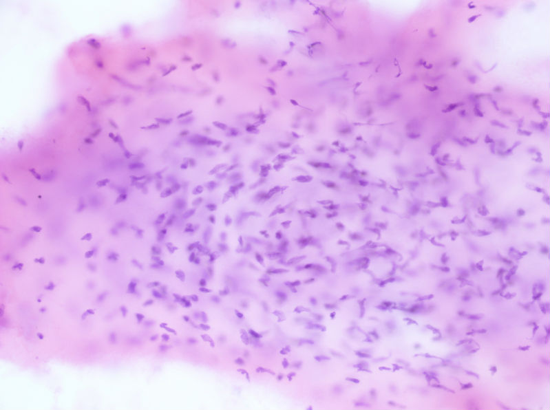 病例分享——女性，乳腺肿块穿刺。图10