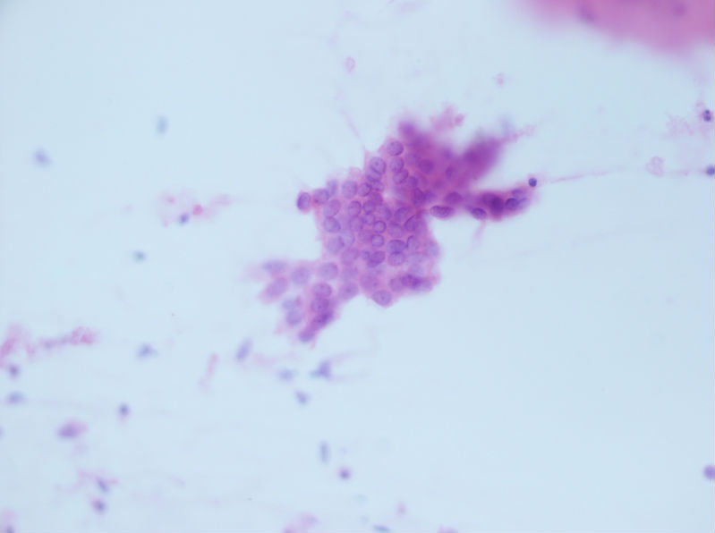 病例分享——女性，乳腺肿块穿刺。图11