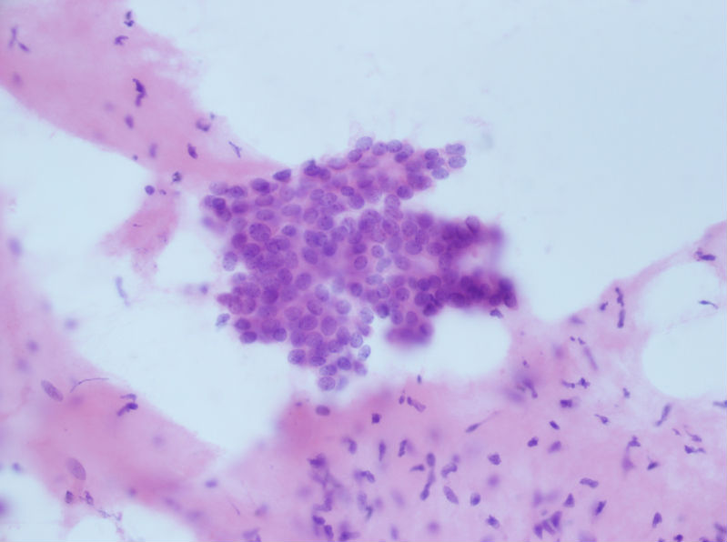 病例分享——女性，乳腺肿块穿刺。图12