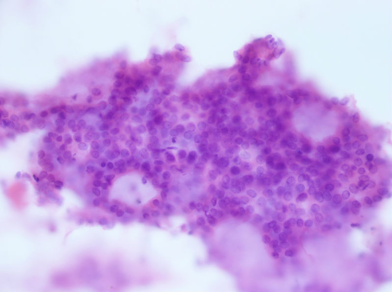 病例分享——女性，乳腺肿块穿刺。图13