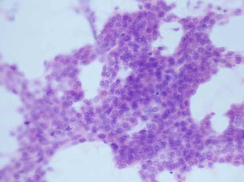 病例分享——女性，乳腺肿块穿刺。图14