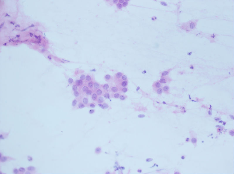 病例分享——女性，乳腺肿块穿刺。图15