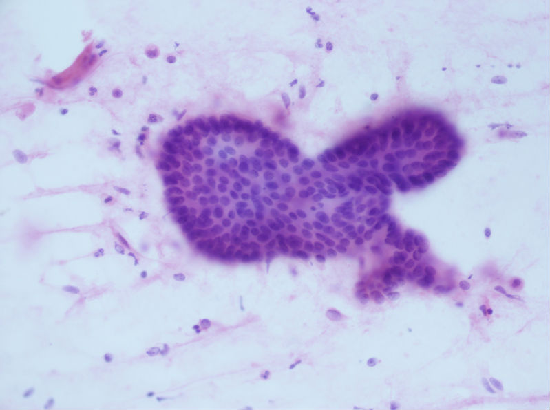 病例分享——女性，乳腺肿块穿刺。图16