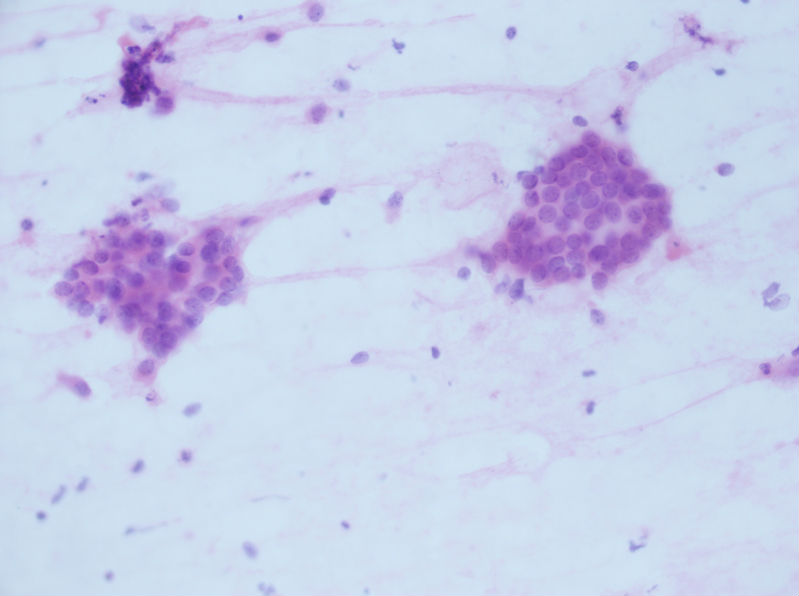 病例分享——女性，乳腺肿块穿刺。图17