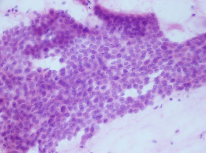 病例分享——女性，乳腺肿块穿刺。图18