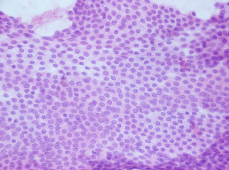 病例分享——女性，乳腺肿块穿刺。图19