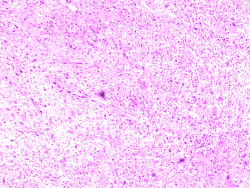 读片会2003 患者女性，48岁，因发现乳腺包块图3