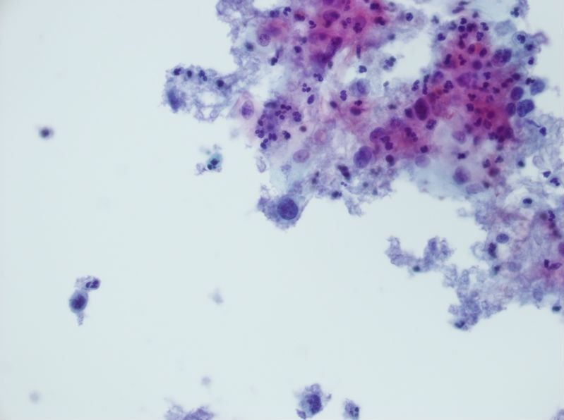 今天碰到的一例TCT，不知道大家会诊断什么？图2