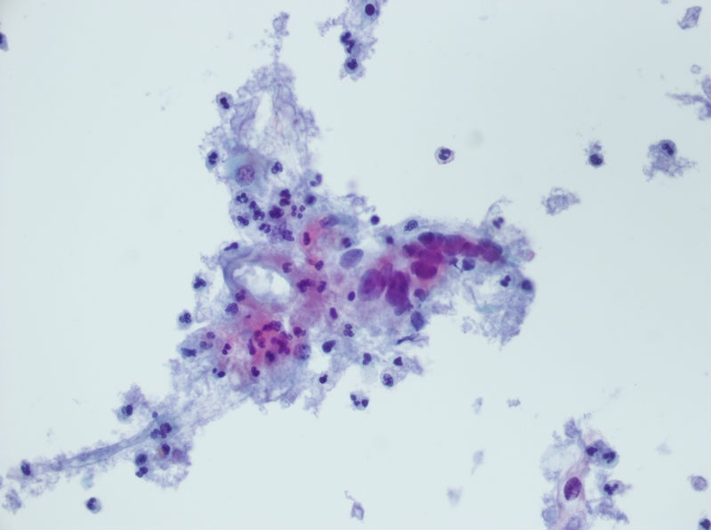 今天碰到的一例TCT，不知道大家会诊断什么？图3