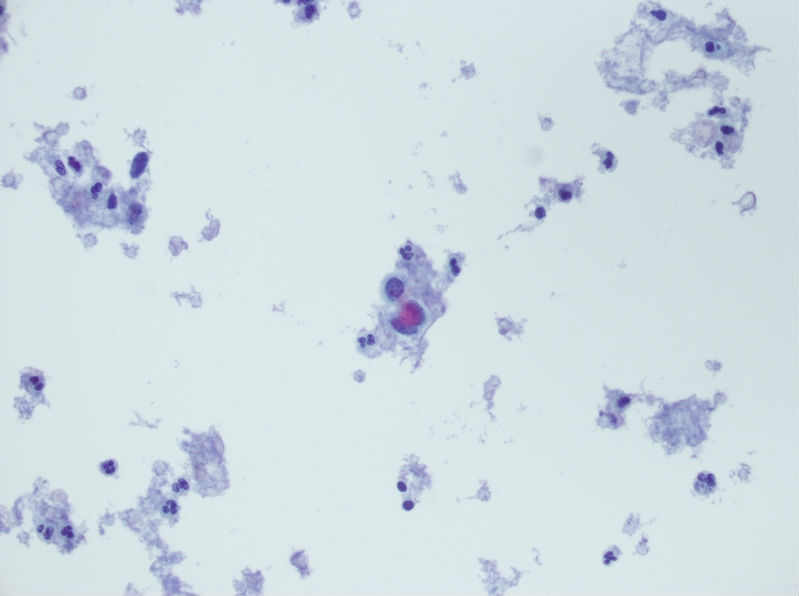 今天碰到的一例TCT，不知道大家会诊断什么？图4