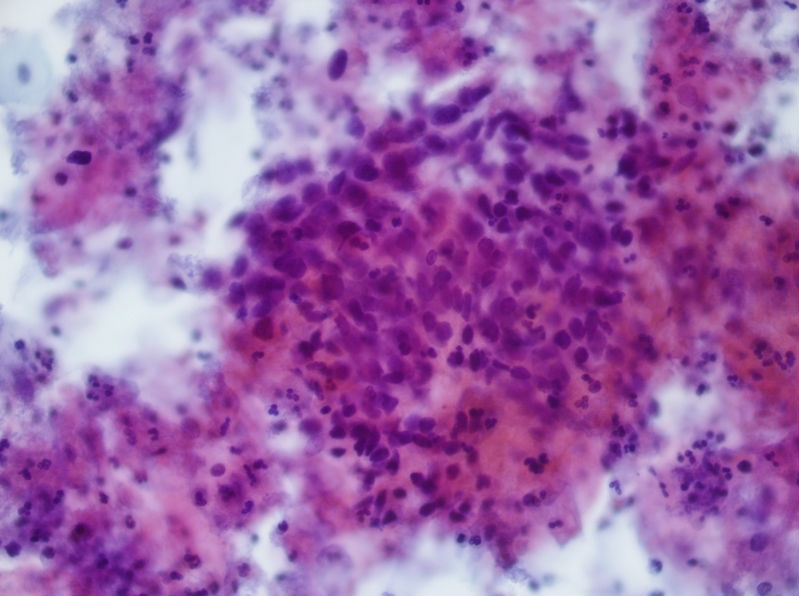 今天碰到的一例TCT，不知道大家会诊断什么？图5