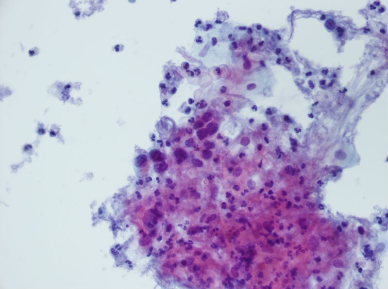 今天碰到的一例TCT，不知道大家会诊断什么？图6