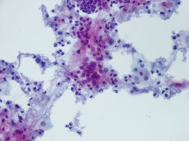 今天碰到的一例TCT，不知道大家会诊断什么？图7