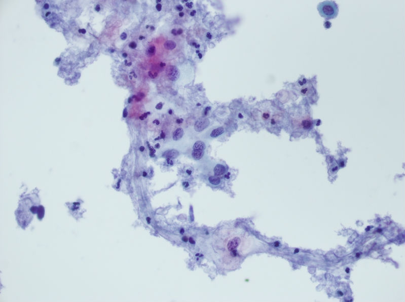 今天碰到的一例TCT，不知道大家会诊断什么？图8
