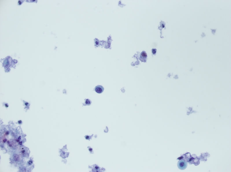 今天碰到的一例TCT，不知道大家会诊断什么？图10