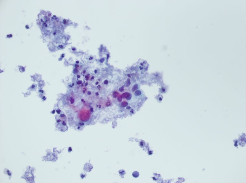 今天碰到的一例TCT，不知道大家会诊断什么？图11