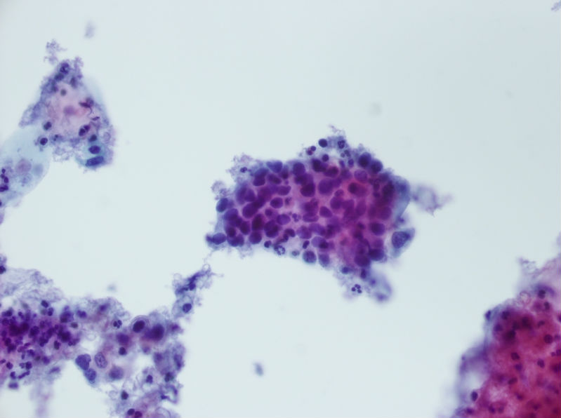 今天碰到的一例TCT，不知道大家会诊断什么？图12