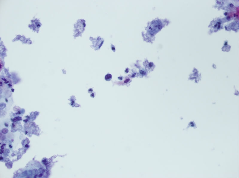 今天碰到的一例TCT，不知道大家会诊断什么？图13