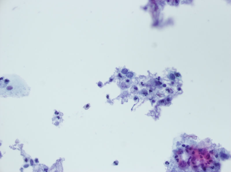 今天碰到的一例TCT，不知道大家会诊断什么？图14