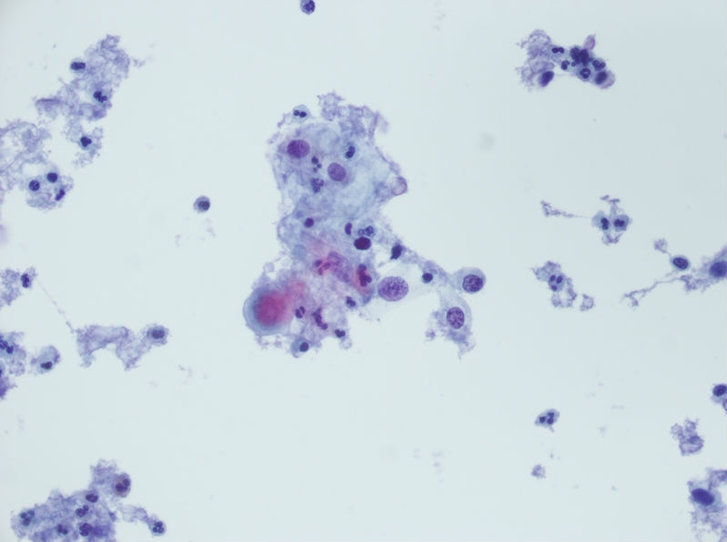 今天碰到的一例TCT，不知道大家会诊断什么？图15