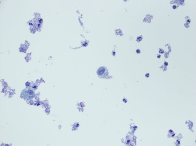 今天碰到的一例TCT，不知道大家会诊断什么？图16