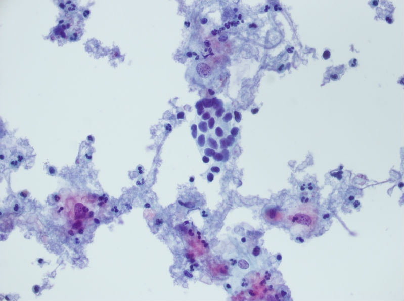 今天碰到的一例TCT，不知道大家会诊断什么？图17