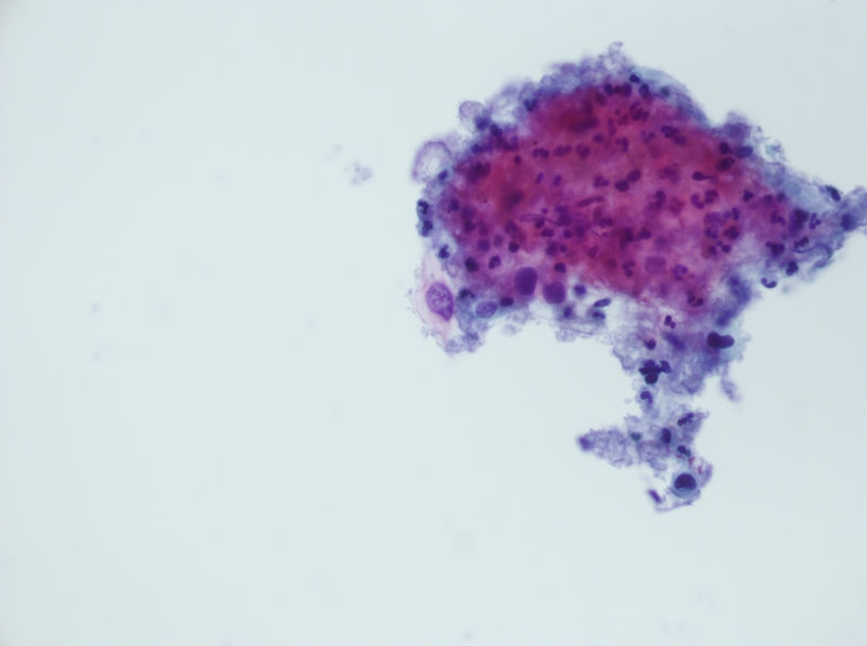 今天碰到的一例TCT，不知道大家会诊断什么？图18