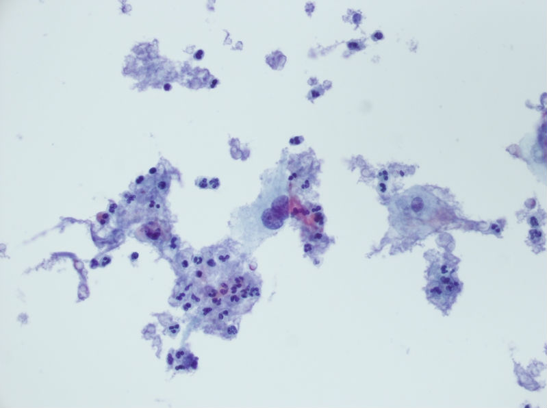 今天碰到的一例TCT，不知道大家会诊断什么？图20