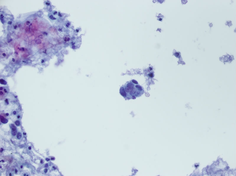 今天碰到的一例TCT，不知道大家会诊断什么？图22
