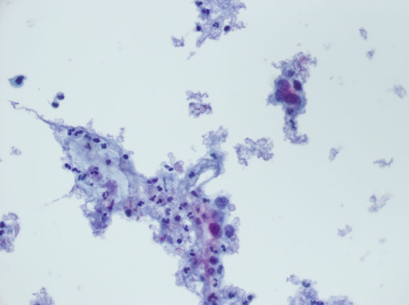 今天碰到的一例TCT，不知道大家会诊断什么？图23