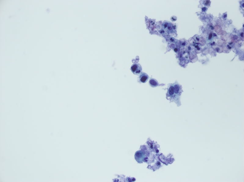 今天碰到的一例TCT，不知道大家会诊断什么？图26